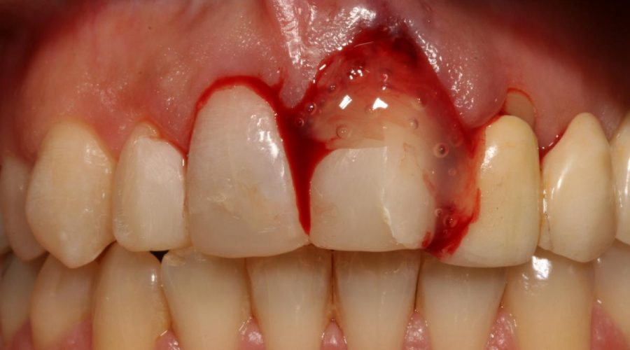 Apsenin Bitkisel Tedavisi, Doğal Çözümü