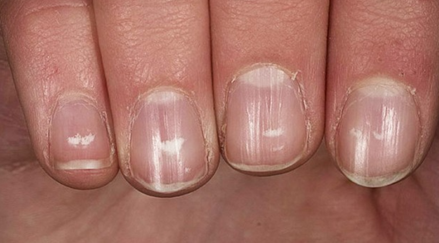 Çinko Eksikliği Belirtileri Nelerdir, Nasıl Anlaşılır?