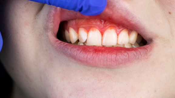 Diş Eti Ağrısına Ne İyi Gelir, Nasıl Geçer?