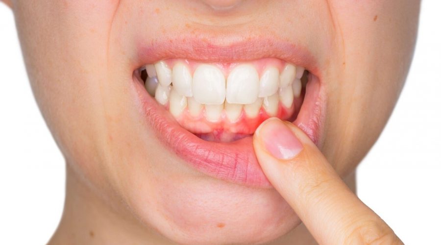  Diş Eti Çekilmesinin Bitkisel Tedavisi, Doğal Çözümü