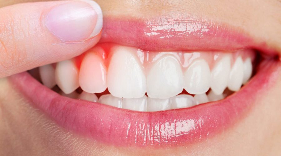 Diş İltihabının Vücuda Yayılma Belirtileri Nelerdir?