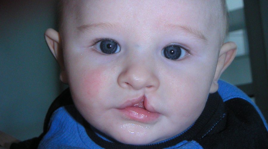 Dudak-Damak Yarığı (DDY) hakkında merak edilenler