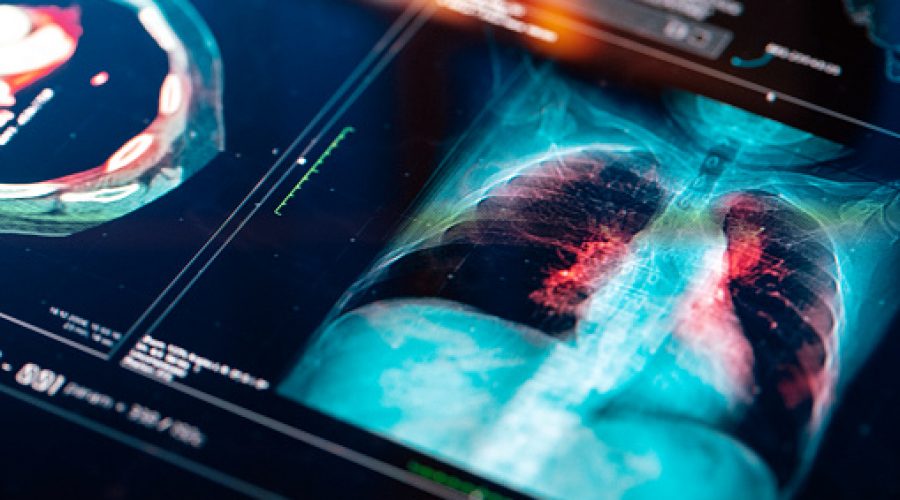 Pulmoner Alveoler Mikrolitiazis Nedir? En Çok Türkiye’de Gözüken Bu Hastalığın Tedavisi Var Mıdır?