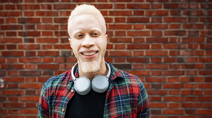 Albino Nedir, Albino Genetik Hastalık Mı?