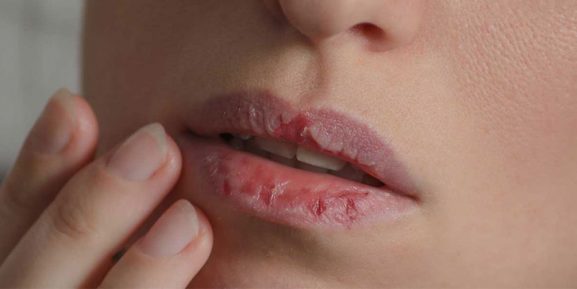 Dudak Yeme Alışkanlığı Nedir? Nedenleri ve Kurtulmanın Yolları Nelerdir?