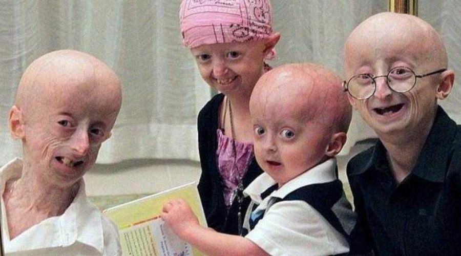 Progeria Nedir, Belirtileri Nelerdir?